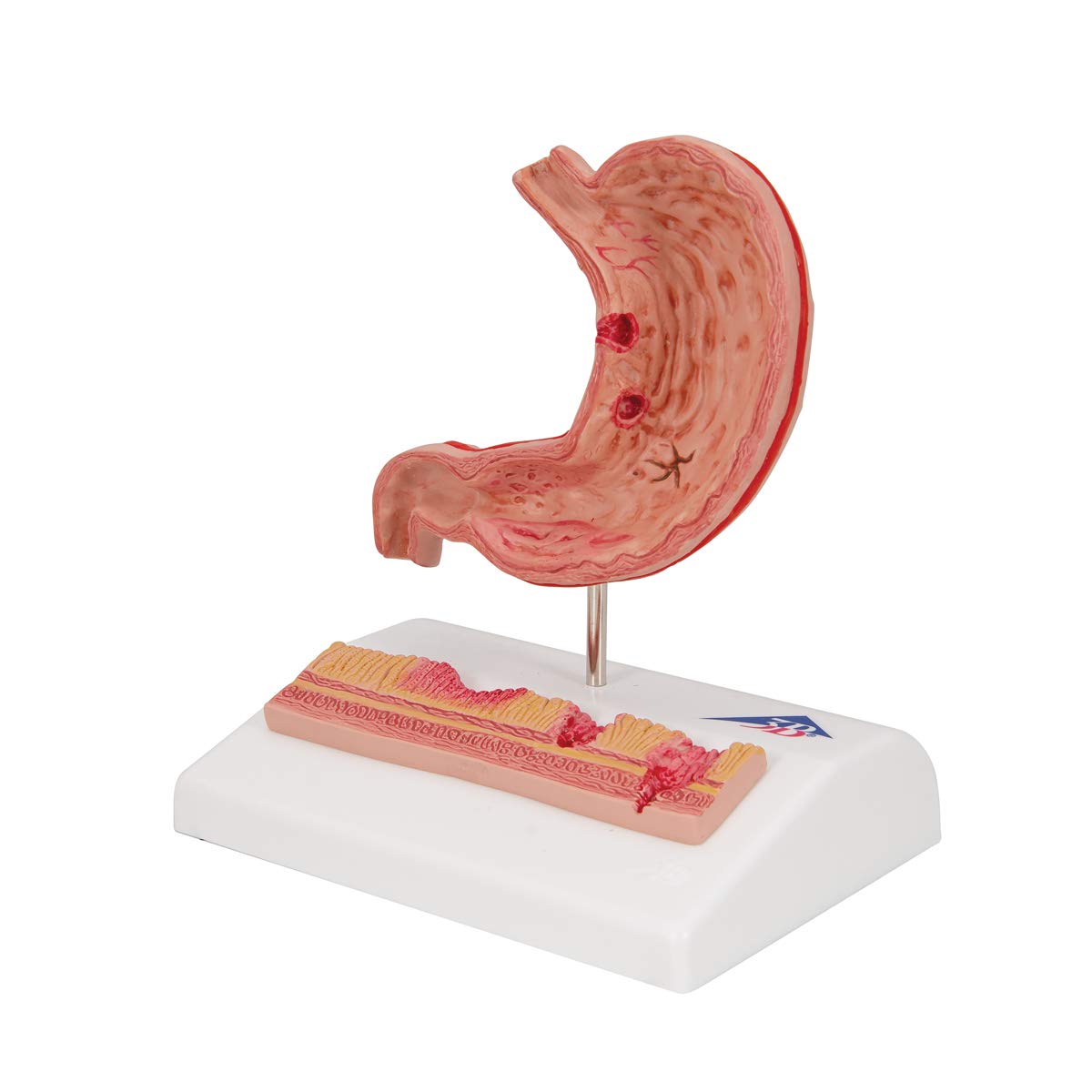 3B Scientific K17 Stomaco con Ulcere Gastriche + software gratuito di anatomia - 3B Smart Anatomy