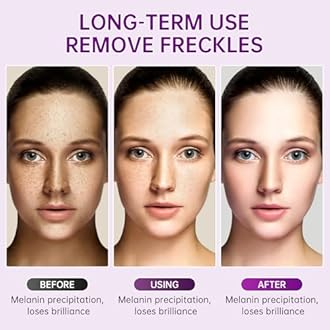 Dark Spot Remover for Face, Niacinamide Freckle Remover Cream for Body, 1 PCS Moisturizing Serum for Skin, Quick Effect to Repair Freckles Melasma Brown Spot.