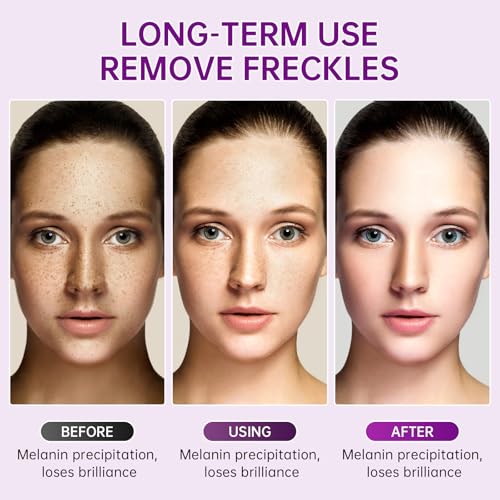 Dark Spot Remover for Face, Niacinamide Freckle Remover Cream for Body, 1 PCS Moisturizing Serum for Skin, Quick Effect to Repair Freckles Melasma Brown Spot.