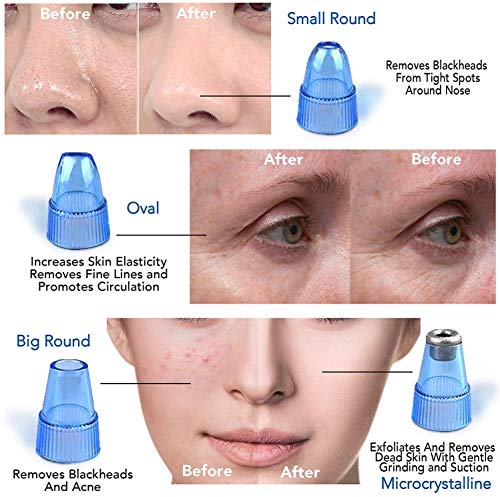 Image of Viulvuk 4 in 1 Electric Blackhead & Whitehead Remover | Powerful Acne Pore Vacuum Suction Cleaner for Effective Skin Care | Multi-Functional Facial Derma Tool for Cleaning Skin & Pore Minimization