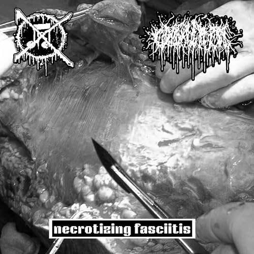  necrotizing fasciitis