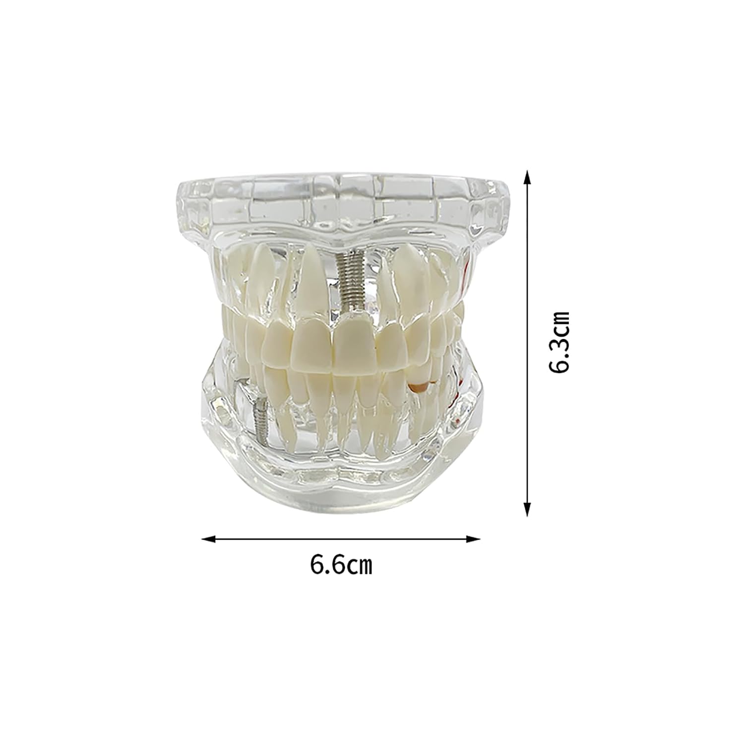 Transparent Implant Teeth Model, YOUYA DENTAL Transparent Dental Implant Disease Teeth Model Dentist Standard Disease Removable Tooth Pathological Teaching Model