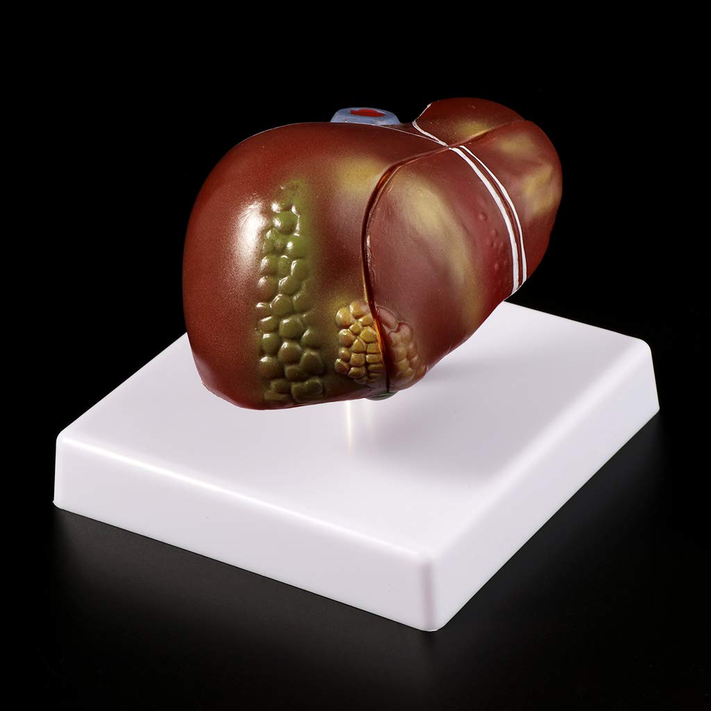 Modelo anatómico patológico del hígado humano, anatomía, escuela, enseñanza, displa
