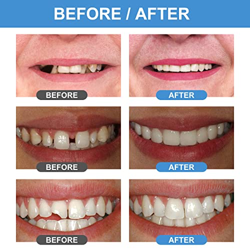Tooth Repair Kit, Fake Teeth For Temporary Fixing The Missing And Broken Tooth Replacements #TOP6