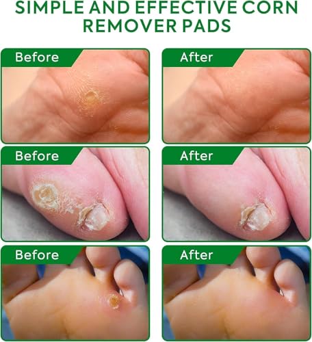 image for SupreH Corn Removers for Toes Feet Bandages: Corn Cushions and Small C