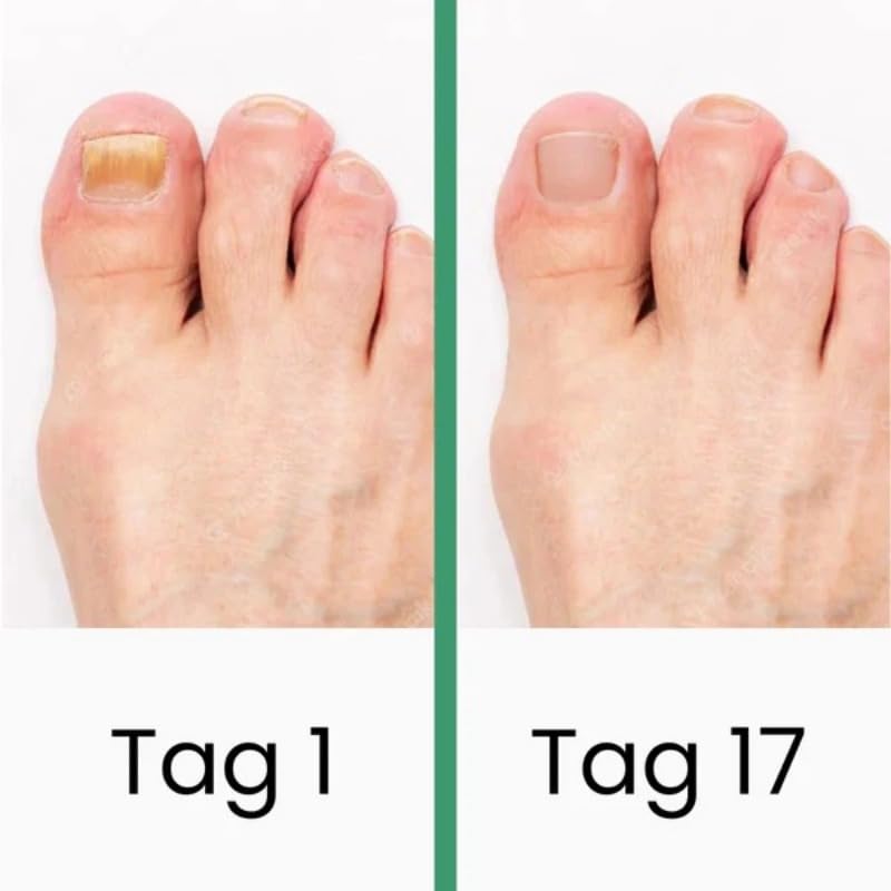 Podomax PODOclip® | LLLT-Nagelpilztherapie(1 Stück)