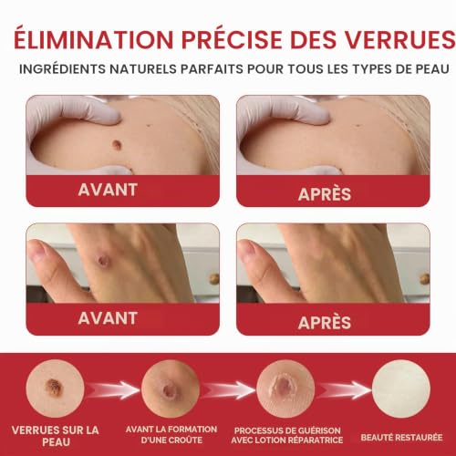 20g Verrues Removal Crème, Crème Hydratante Hydratante, Verrue Plantaire Pommade anti-verrues, Pour le visage et le Corps – vue 2