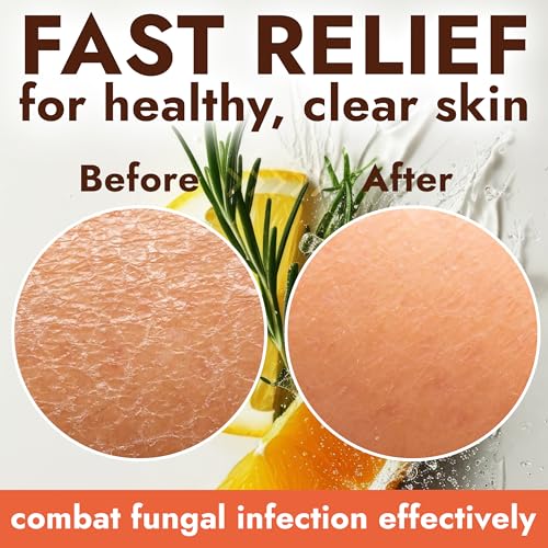 Image of Antifungal Soap with Lemon Oil 1% Tolnaftate for Jock Itch & Ringworm | Medicated Jock Itch Treatment Helps Fight Ringworm & Athlete's Foot 2 Cleansing Bars with Case Sweet Orange & Grapefruit Oils