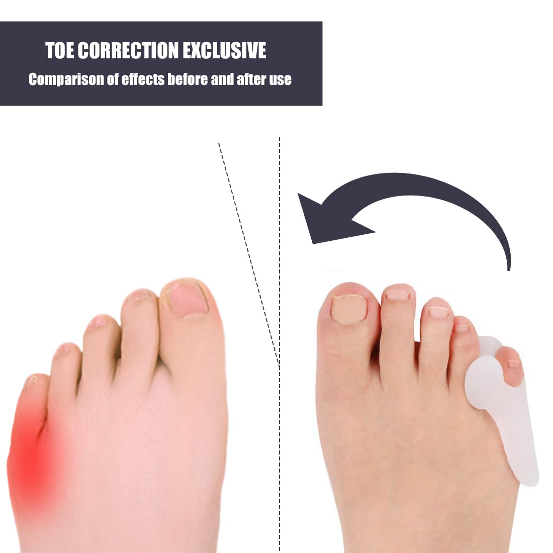 Bunionette Corrector, 6 Unidades de Corrector de Dedo pequeño, Silicona, Gel para Hombres y Mujeres, Garra, tamaño para Todos los esparcidores pequeños