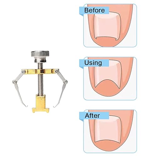 Miniatura 6 de Ingrown Toenail Corrector Professional Ingrown Toenail Lifter Practical Toe Clamp for Ingrown Toenail Treatment