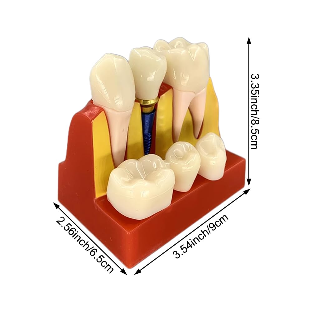 Modèle D'implant Dentaire - Modèle De Dent De Démonstration Pour Couronne Bridge Amovibles (4 Fois) - Modèle De Dent Pour L'analyse D'implants Dentaires À Des Fins D'apprentissage De Formation