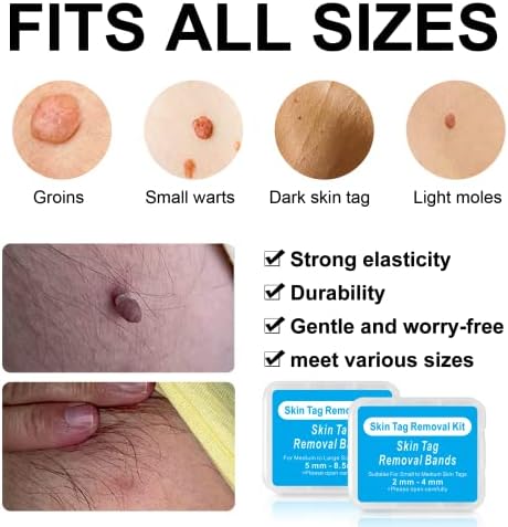 Skin Tag Remover Kit - 20Pcs Skin Tag Removal Rubber Bands Large Size (5mm-8.5mm) & 20Pcs Skin Tag Removal Bands Small to Medium Sized (2mm-4mm) & 40Pcs Alcohol Pads (A 20+20+40)