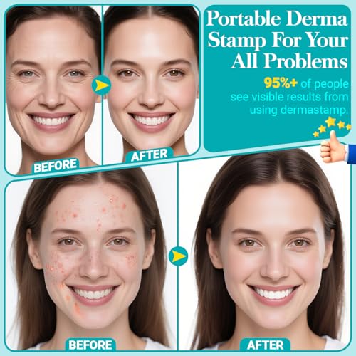 Stempel Derma Microneeedling - ROMMQB Microneedling Pieczęci Do włosów Twarzy Skóry Głowy Vrody, Microneedle Dermastamp w Domu, Pielęgnacja Skóry i Włosów Narzędzie Do Wzrostu Brody