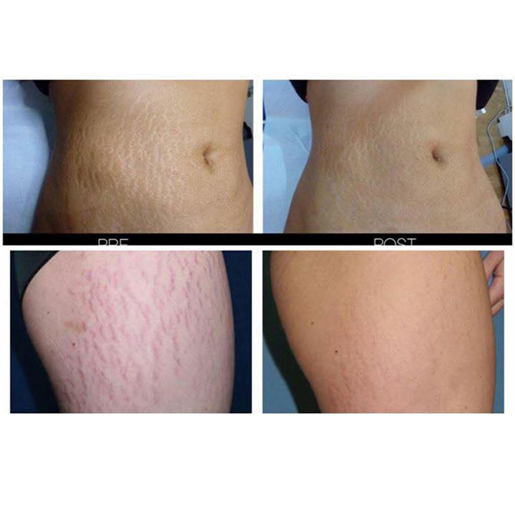Provamed Stretch Mark Cream 200 G.(Honest Succeed)
