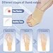 DR JK- Bunion Corrector for Women and Men, 2 pcs, Beige, Big Toe Straightener for Bunions Relief, Bunion Splint for Hallux Valgus