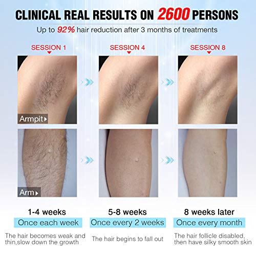 Permanent Hair Removal for Women & Men, IMENE 500,000 Flashes Home Use Hair Removal - Ideal for Full Body Bikini, Legs, Arms, Armpits Hair Remover - Uses Most Effective and Safe Technology - Thumbnail 3