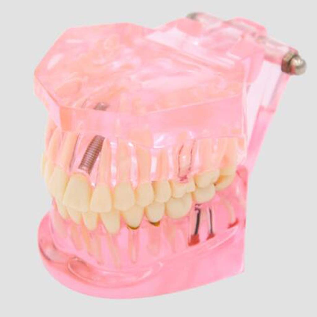 Modello Anatomico dei Denti - Modello di Dente per Addestramento alle Operazioni Ortodontiche Staccabili Trasparenti - per Aiuti allo Studio Educativo Medico, Attrezzature da Laboratorio