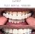 JMBK Veneer Teeth, Fake Teeth, Veneers Snap in Teeth, Teeth Dental Veneers, Instant Veneers Dentures Fake Teeth Smile Men and Women(Top and Bottom),2 Pairs