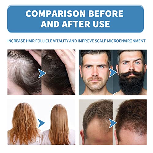 Re:ACT Minoxi Roll-On Hair Treatment,2023 New Hair...