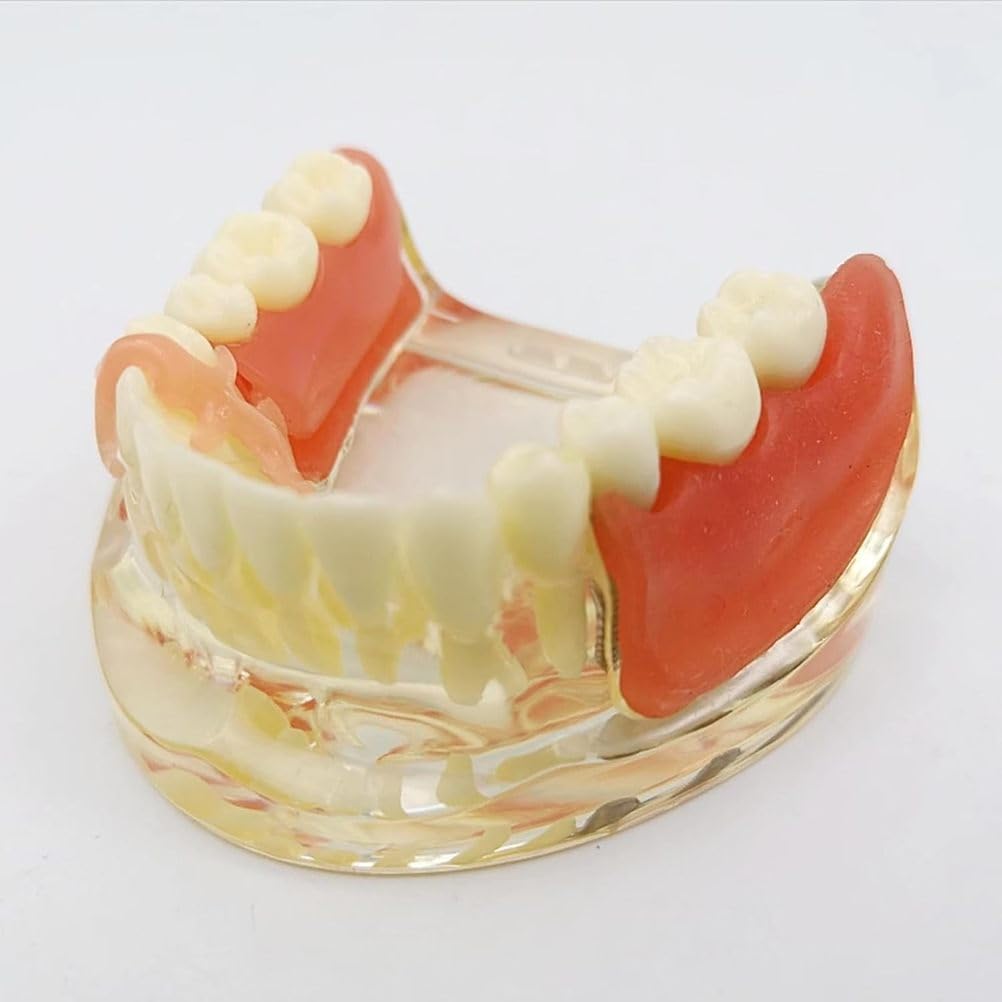 Implant-Supported Restorations Comparison Model Transparent Dental Implant Model Education Study
