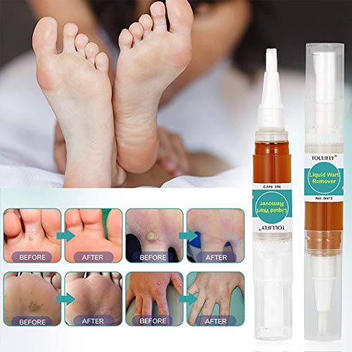 Wart Remover,Foot Wart Remover,Plantar Wart Remover,Wart Remover Liquid Pen Corn Callus Remover Liquid for Common Warts Plantar Corn Callus Stops Wart Regrowth