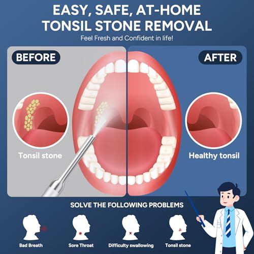Tonsil Stone Remover with Camera