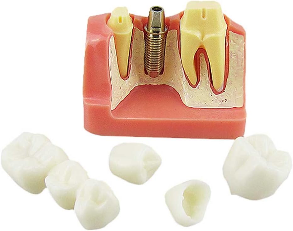 Dental Implant Study Analysis Crown Bridge Demonstration Teeth Model