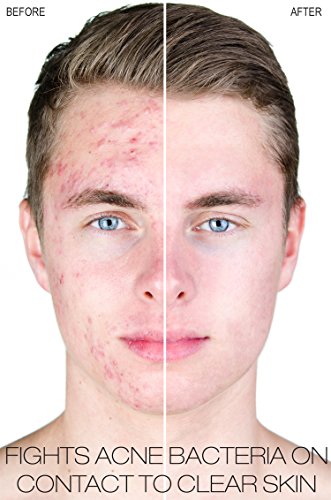 Benzoyl Peroxide 10% Severe Acne Cleanser- Clinically Proven Wash To Fight Acne Bacteria On Contact For Cystic Breakouts, Oily Skin, Clogged Pores, Blackhead & Whitehead Pimples For Face & Body. #TOP1