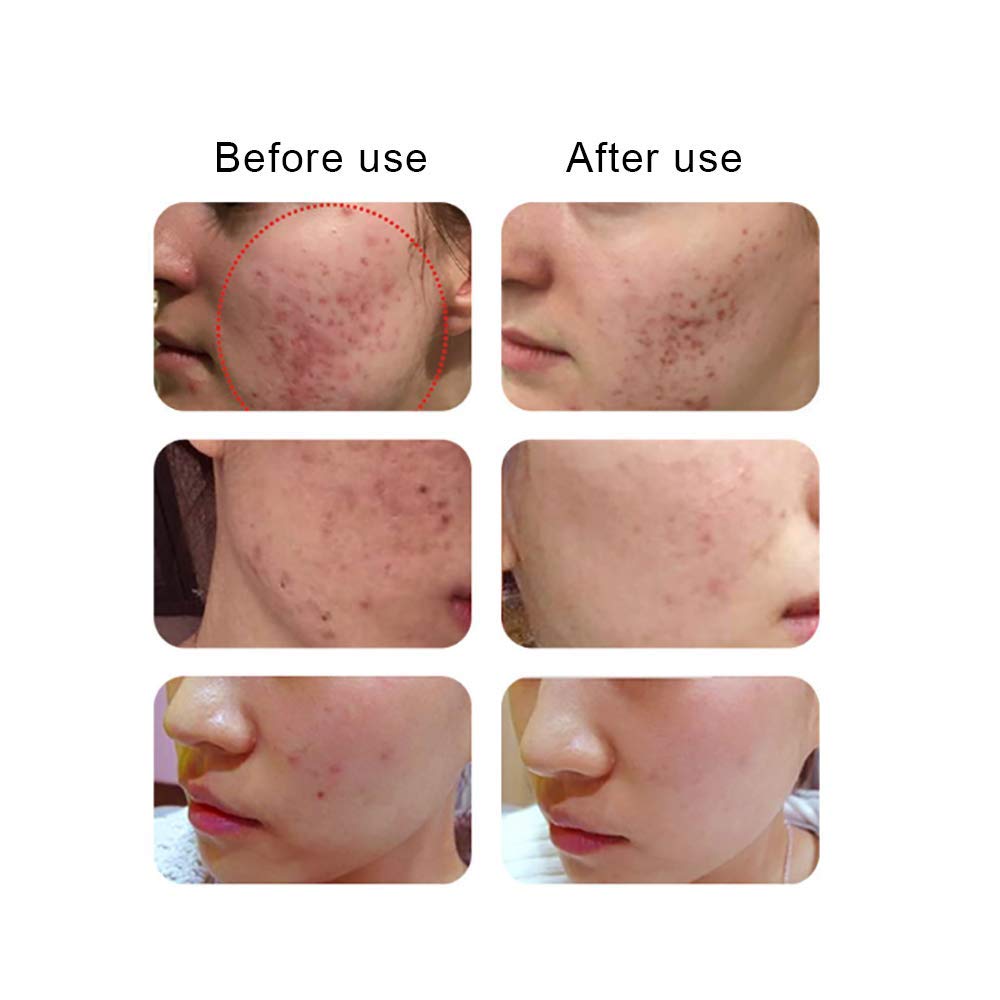 Strumento elettrico di bellezza, sterilizzazione per acne, rughe, plasma facciale antietà oltre allo strumento di bellezza per acari, altamente permeabile, nessuna radiazione non danneggia la pel