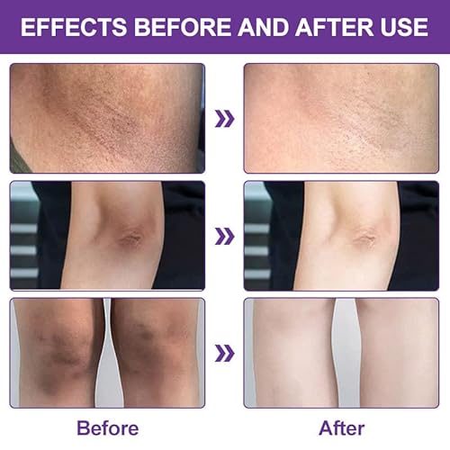 5 Pcs Dark Spot Remover Corrector Cream For Underarms, Armpit, Knees, Elbows And Inner Thigh, Body Cream For Sensitive Areas (1.76 Fl Oz) #TOP2