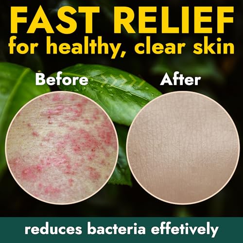 Image of Antibacterial Soap for Back Acne, Body Odor & Skin Irritation Kills Germs