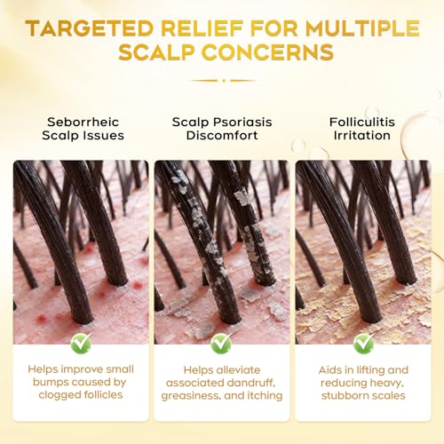 Image of Enhanced Antifungal Shampoo for Seborrheic Dermatitis & Folliculitis-Fresh