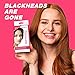Blackhead Pore Strips, KOTAMU Blackhead Removal Deep Cleansing Pore Strips For Nose 20 Count Unclogging
