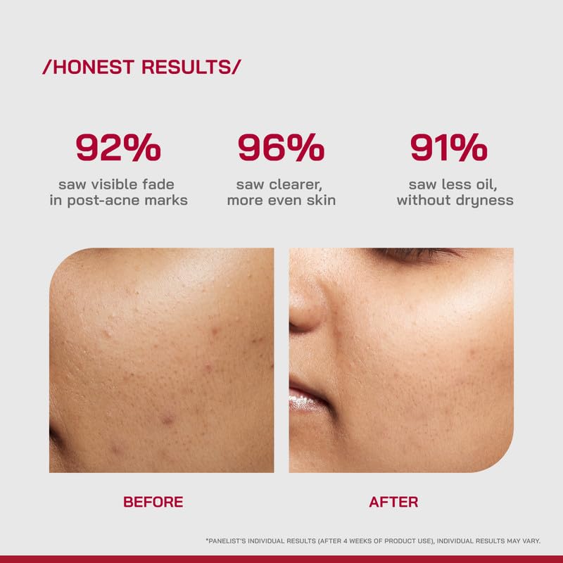 Image of /PHD / 10% Niacinamide Spot Correcting Serum | Niacinamide for Oily Skin, Acne Scars & Enlarged Pores | Face Serum for Acne-Prone Skin with 2% NAG | Fades Marks, Controls Oil I 90ml