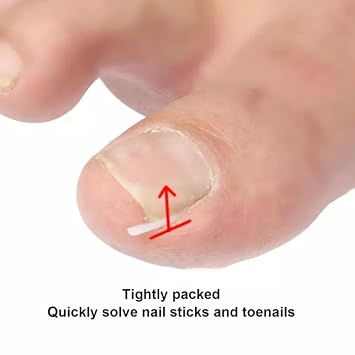 10 Pcs Ingrown Toenail Correction Strips Brace Kit, Ingrown Toenail Corrector Straightener Strips Recover Clips Toenails Thick Pedicure Tool Toenail Straightener Strip for Men Women Foot Care Tools