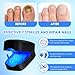 aparato de Cuidado Micosis Uñas Imagen de aparato de Cuidado Micosis Uñas