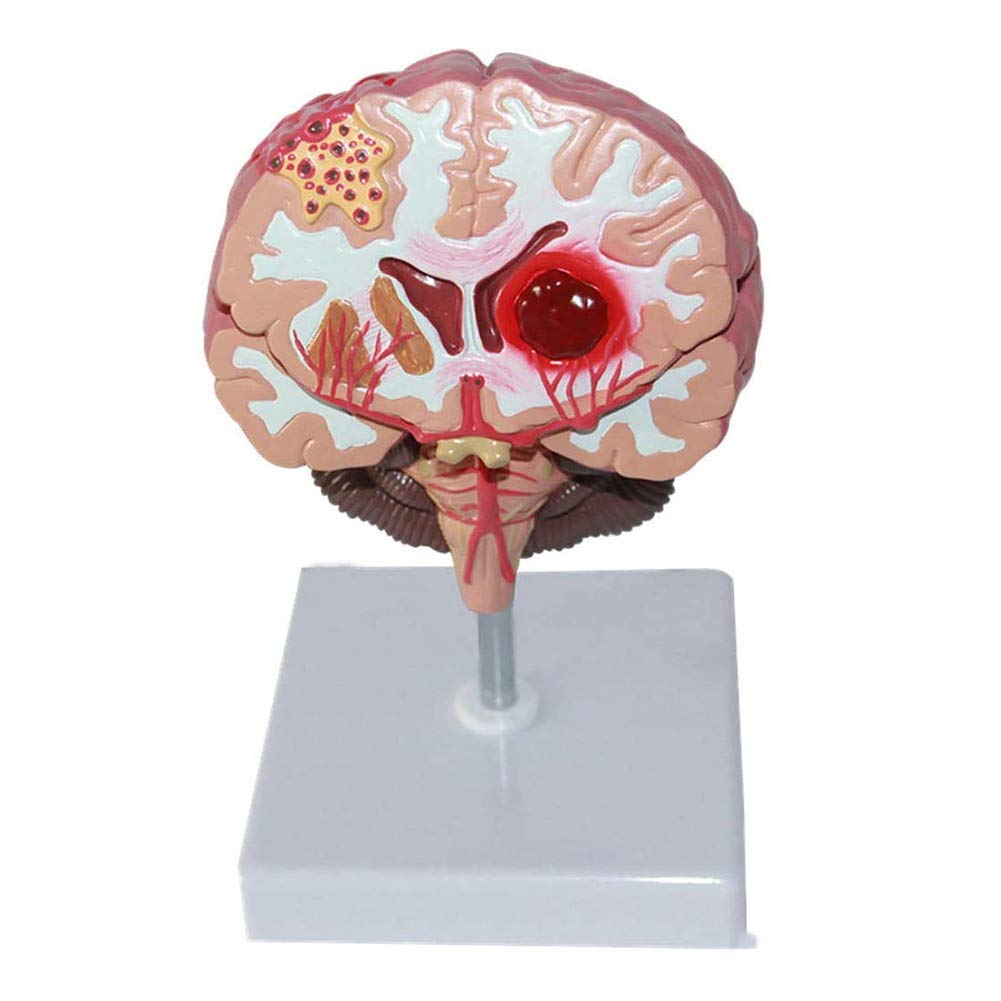 Sjdopulse Gray Human Brain Disease Model-Brain Lesion Model-Cerebral Hemorrhage And Aneurysm And Cerebral Arteriovenous Malformation Pathology
