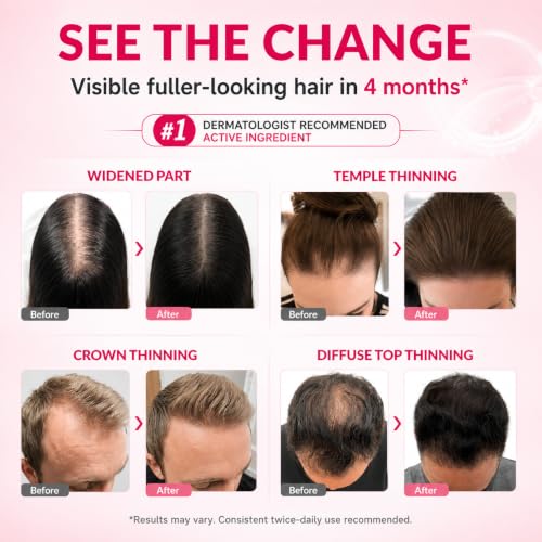 Image of 5% Minoxidil for Women Hair Growth: Minoxidil for Men - Topical Minoxidil Spray for Women - Hair Growth Serum Minoxidil with Biotin - Regrow Stronger Thicker Longer Hair - Hair Loss Solution, 2 Pack