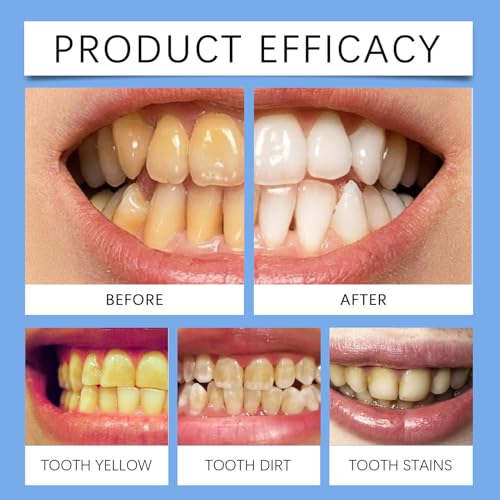 Zahnfleckenentferner, Werkzeug zum Entfernen von Zahnflecken - Effizienter Zahnradierer, Polierer, Zahnfleckenentferner - Kompaktes Zahnfleckenentferner-Werkzeug, Zahnreinigungsschwämme für Damen und – Bild 6