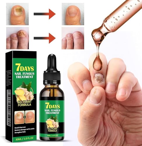 【銷量第一】2025 New 3Pcs Ginger Nail Treatment Nail Support Nail Care, 7 Days Nail Treatment for Nail Care, Ginger Nail Growth Serum, Ginger Cuticle Care Oil for Nails, 30ML/1FL.OZ - Image 3