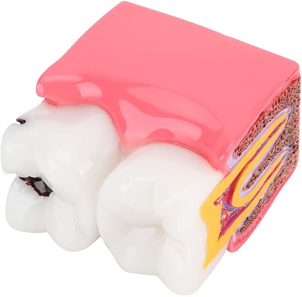 Modelo de Dientes dentales Resina Caries Estudio de comparación Modelo de sección Transversal de Dientes Anatomía Dentista Educación Dental Modelo para Estudios dentales
