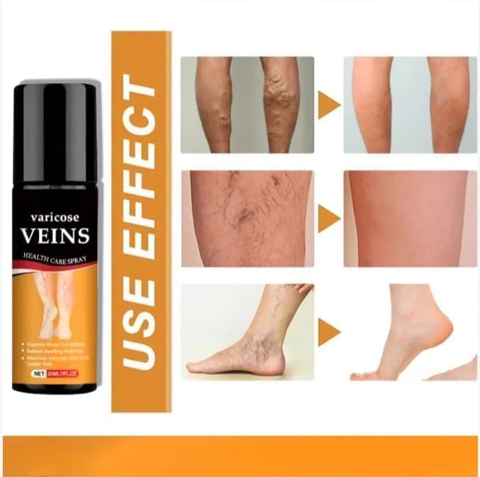 Image of Varicose Veins Spray - Natural Herbal Formula for Fast Relief | Reduces Swelling, Relieves Pain & Promotes Blood Circulation | Easy-to-Use Spray for Legs, Ankles & Feet (PACK OF 2, 60 ML)