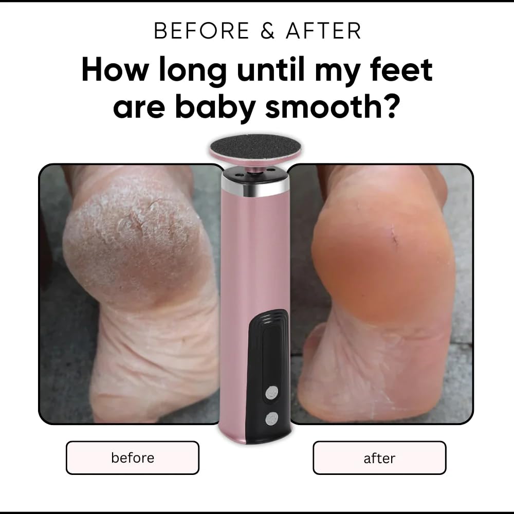 Limaor Electric Foot Callus Remover 2-in-1 Hornhautentferner USB-C Fußpflegegerät mit austauschbaren Fußfeilen, 6 Geschwindigkeiten
