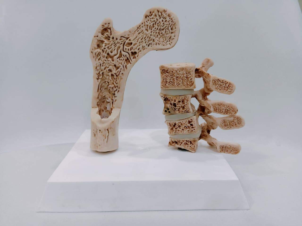 Kay Kay Industries || Cut Section of Femur and Vertebrae Osteoporosis Model for Bone Disease Demonstration for medical professional, Anatomically Accurate and Premium Quality
