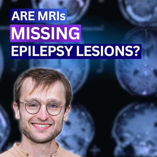MRIs Miss Brain Lesions Causing Epilepsy - AI Can Find Them - Dr. Konrad Wagstyl