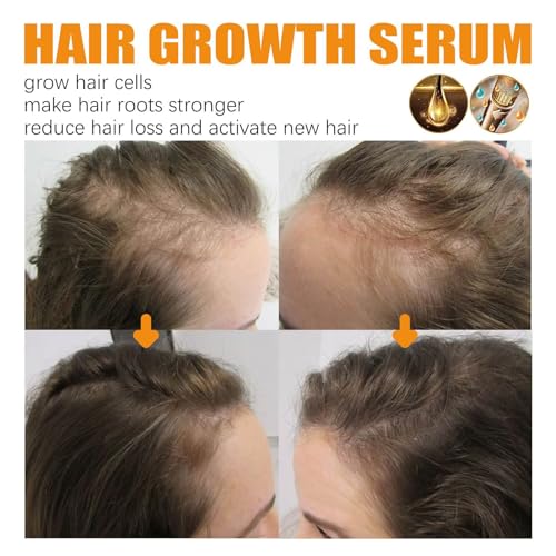 Biancat LuxusBiotin Haarwuchs Serum, Ibealee Biotin Haarwuchsspray, Biotin-Haarwachstumsseren, Bio Haarwachstumsspray, Biotin Haarwachstumsserum, Anti-Haarausfall Haarspray (5PCS)