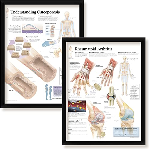 Set of 2 Framed Medical Posters Understanding Osteoporosis and Rheumatoid Arthritis 22