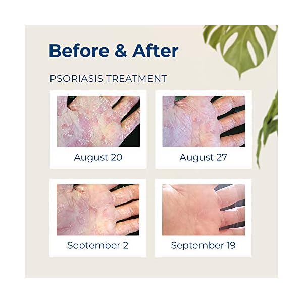 Gloves-In-A-Bottle-Shielding-Lotion-for-Dry-Skin-8-Ounce Gloves In A Bottle Shielding Lotion, Relief for Eczema and Psoriasis, 8 Fl Oz (Pack of 1)