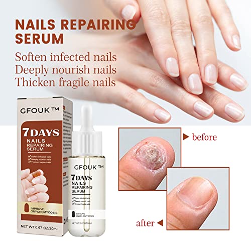 Gfouk 7 Days Nail Growth And Strengthening Serum, Toenail Repair Treatment, Nail Growth And Strength Serum, Nail Repair Solution, Natural Toenail Treatment Oil For Nails (3Pcs) #TOP2