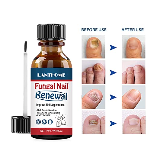 Easilydays Nail Repair Essnce Liquid, Fingernail And Toenail Repair, Fix & Renew Damaged, Broken, Cracked & Discolored Nails, Reduce Nail Thickening, Strengthen Nails For Beautiful Nail #TOP3